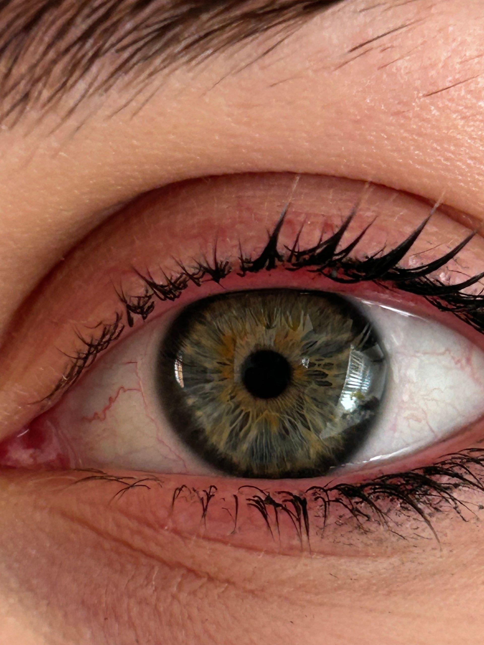 Eye Pain or Redness: When It’s an Emergency