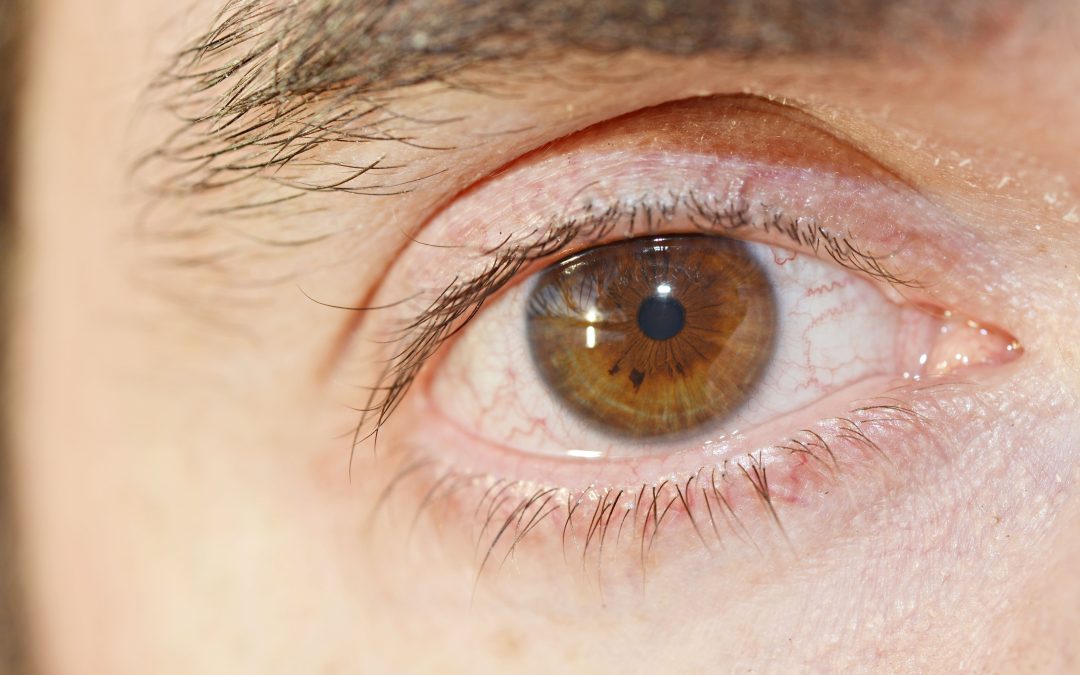 Pink Eye (Conjunctivitis): Types, Causes, and When to See a Doctor