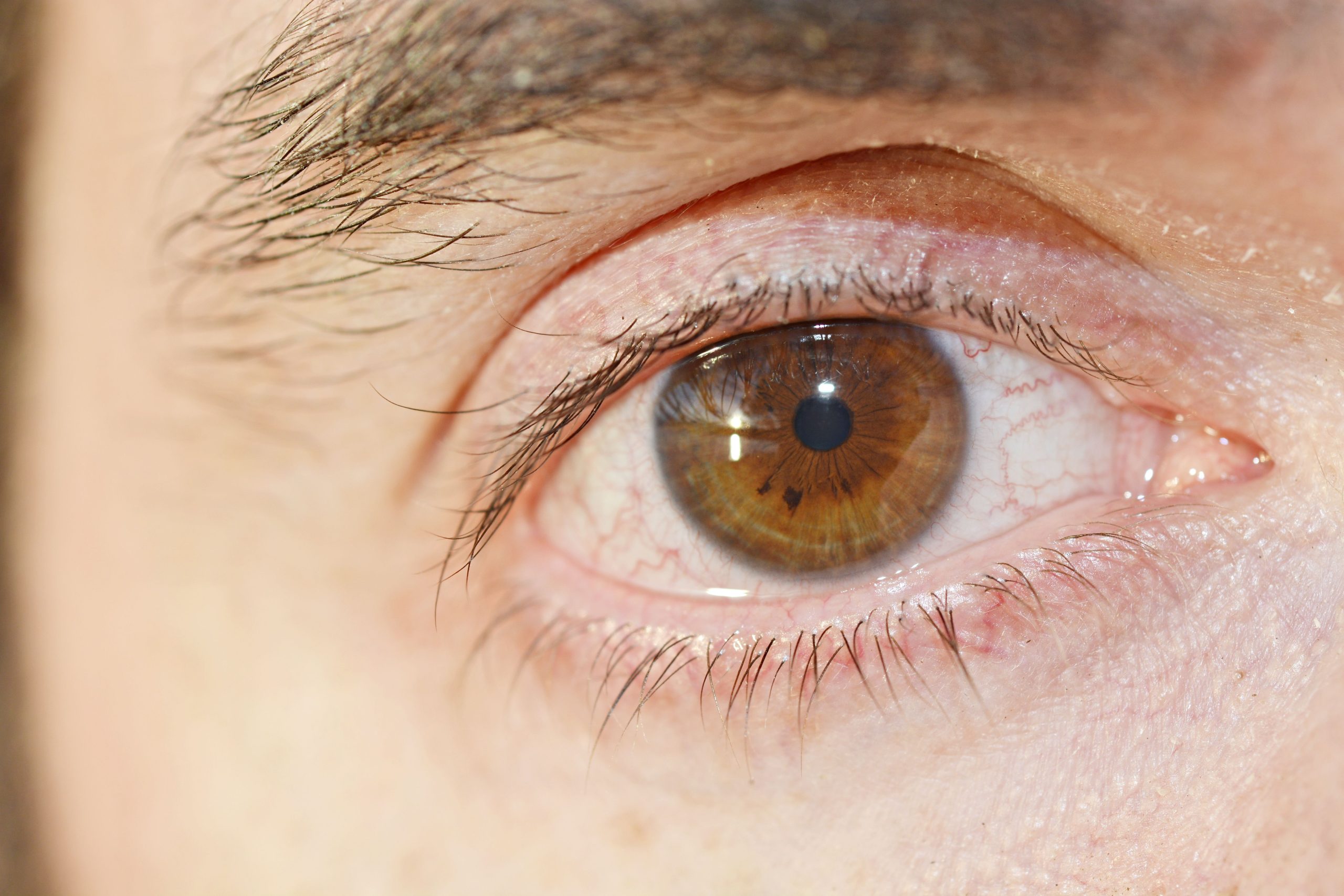 Pink Eye (Conjunctivitis): Types, Causes, and When to See a Doctor