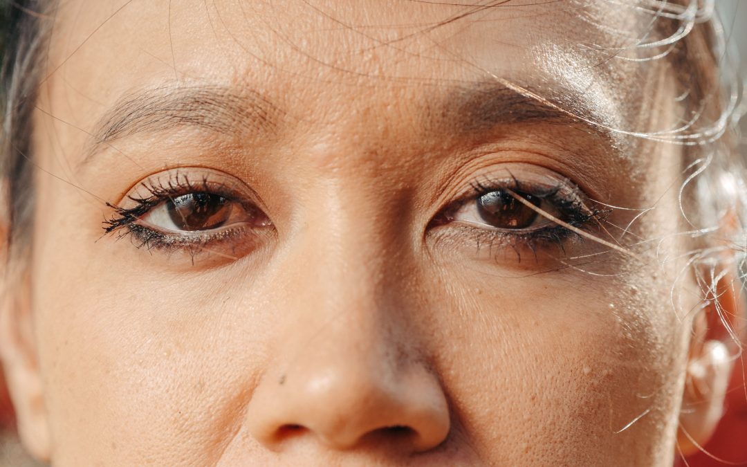 Understanding Blepharitis: Chronic Eyelid Inflammation Explained