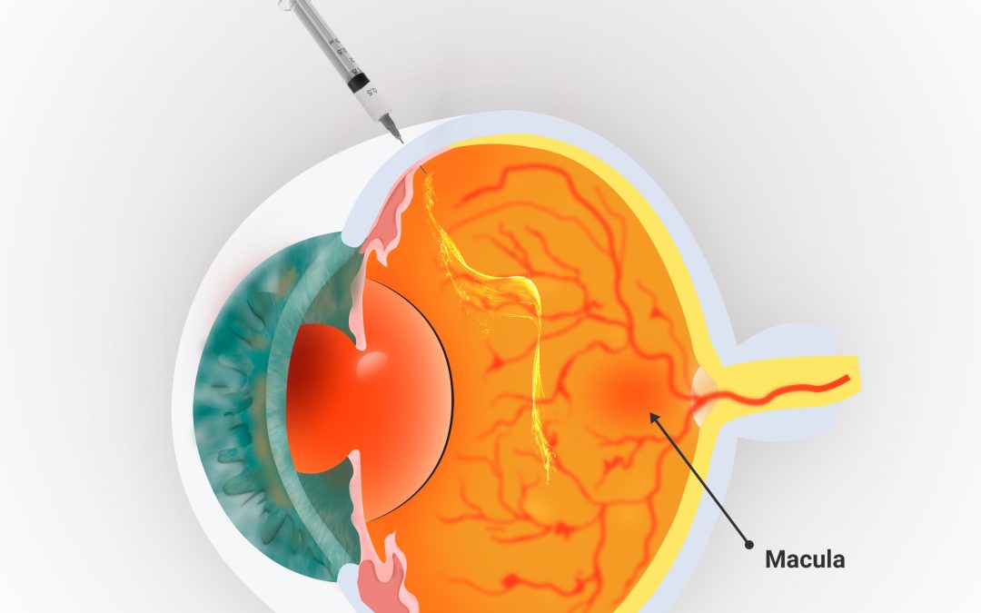 Anti-VEGF Eye Injections: Treating Wet AMD and Diabetic Eye Disease