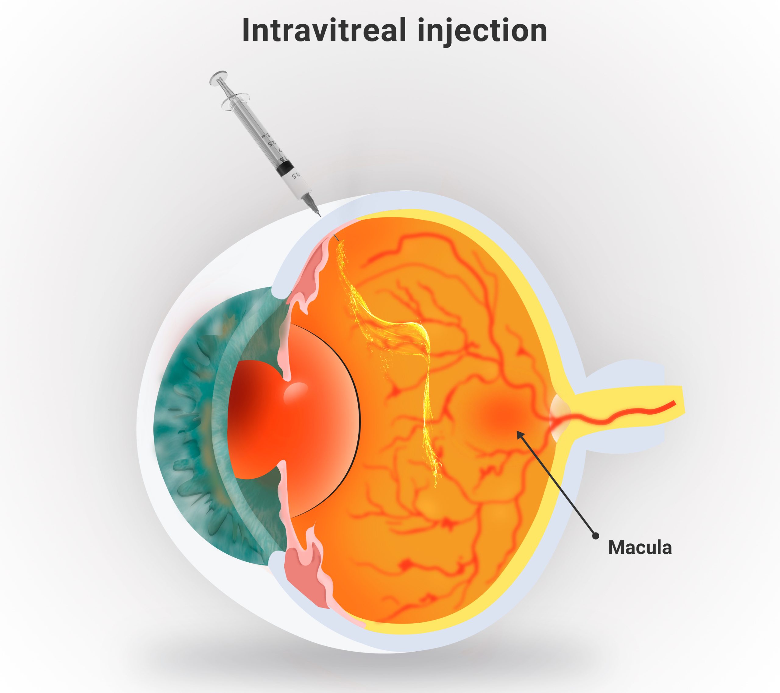 Diagram of an intravitreal injection into the eye, with the macula labeled